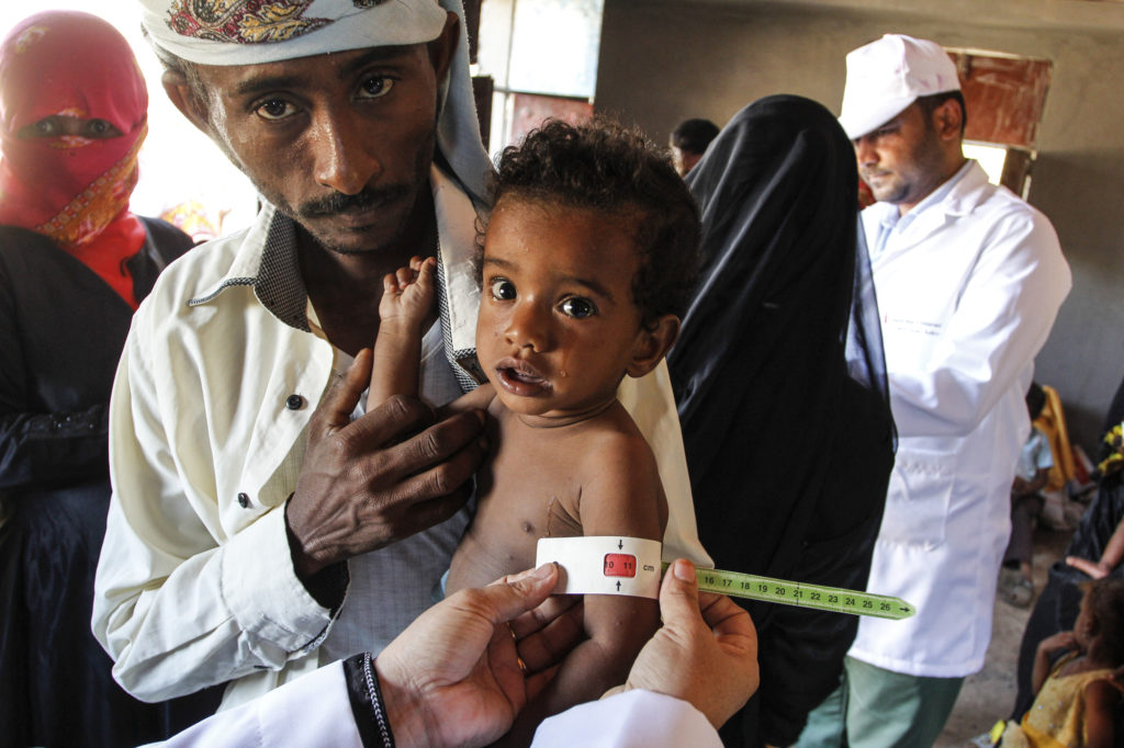 Alerta Save The Children muerte por desnutrición de 85 mil niños y niñas en Yemen