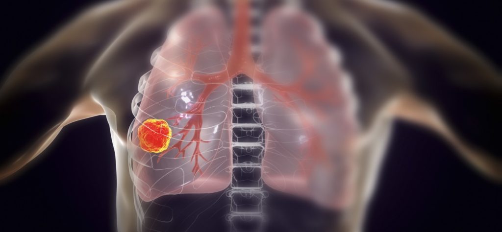Nuevo tratamiento reduce 80% el cáncer de pulmón