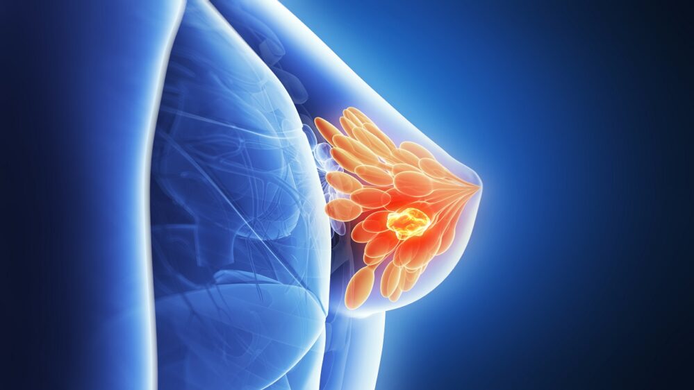 Nueva investigación encuentra gen que podría ser causa de cáncer de mama