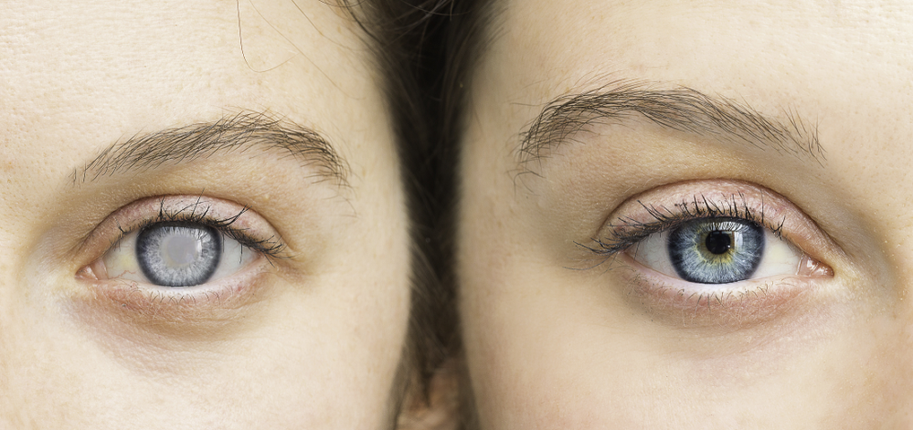 No descuides tus ojos, aquí te decimos lo que debes saber del Glaucoma