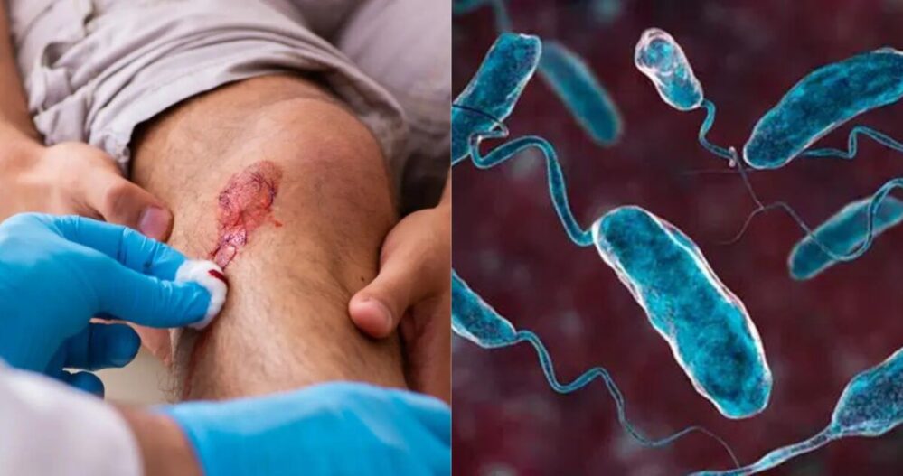 Alerta en Estados Unidos por infecciones de Vibrio vulnificus, la «bacteria carnívora»